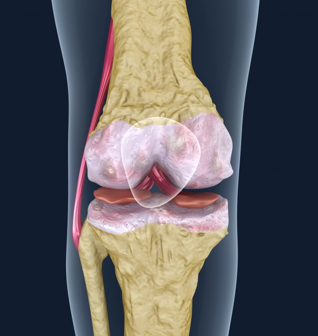 osteoporosis of the knee joint Modelo 3D .c4d .max .obj .3ds .fbx .stl .blend 