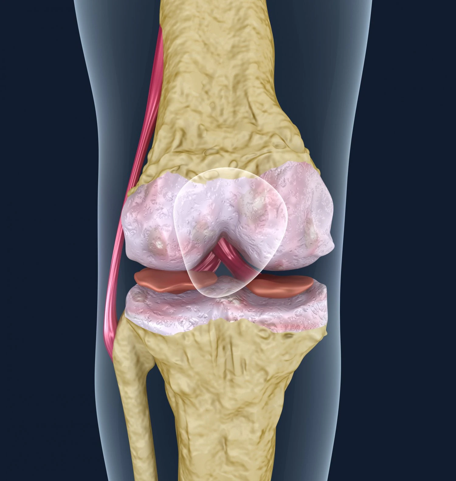 osteoporosis of the knee joint 3D Model .c4d .max .obj .3ds .fbx .stl .blend 