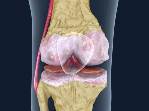 diz ekleminin osteoporozu 3D Model