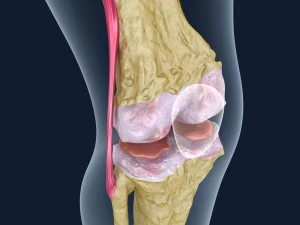 osteoporosis of the knee joint 3D Model