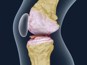 osteoporosis of the knee joint Modelo 3D