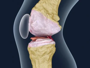 osteoporosis of the knee joint 3D Model
