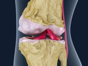 osteoporosis of the knee joint 3D Model