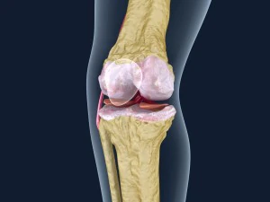 osteoporosis of the knee joint 3D Model