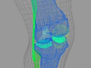 osteoporosis of the knee joint 3D Model