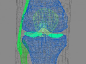 osteoporosis of the knee joint Modelo 3D