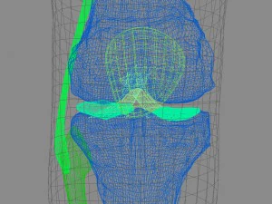 osteoporosis of the knee joint 3D Model