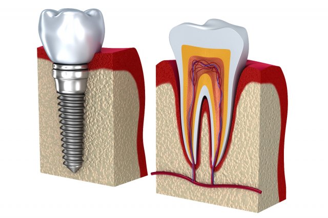 anatomy of healthy teeth and dental implant in jaw Model 3D .c4d .max .obj .3ds .fbx .stl .blend 