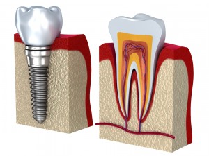 anatomy of healthy teeth and dental implant in jaw 3D Model