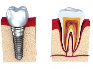 anatomy of healthy teeth and dental implant in jaw 3D Model