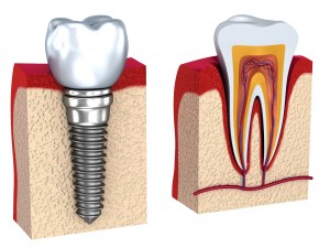 anatomy of healthy teeth and dental implant in jaw Model 3D