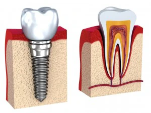 anatomy of healthy teeth and dental implant in jaw 3D Model
