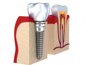 anatomy of healthy teeth and dental implant in jaw Model 3D