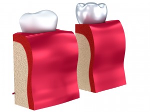 anatomy of healthy teeth and dental implant in jaw Model 3D