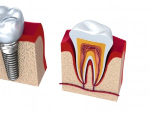 anatomy of healthy teeth and dental implant in jaw Model 3D