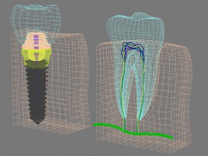 anatomy of healthy teeth and dental implant in jaw Model 3D