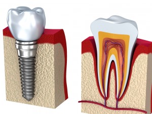 anatomy of healthy teeth and dental implant in jaw Model 3D