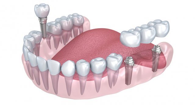lower teeth crown and dental implant 3D Модель .c4d .max .obj .3ds .fbx .stl .blend 
