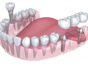 lower teeth crown and dental implant 3D Model