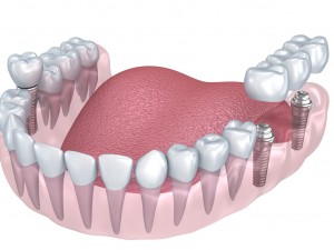 lower teeth crown and dental implant 3D Модель