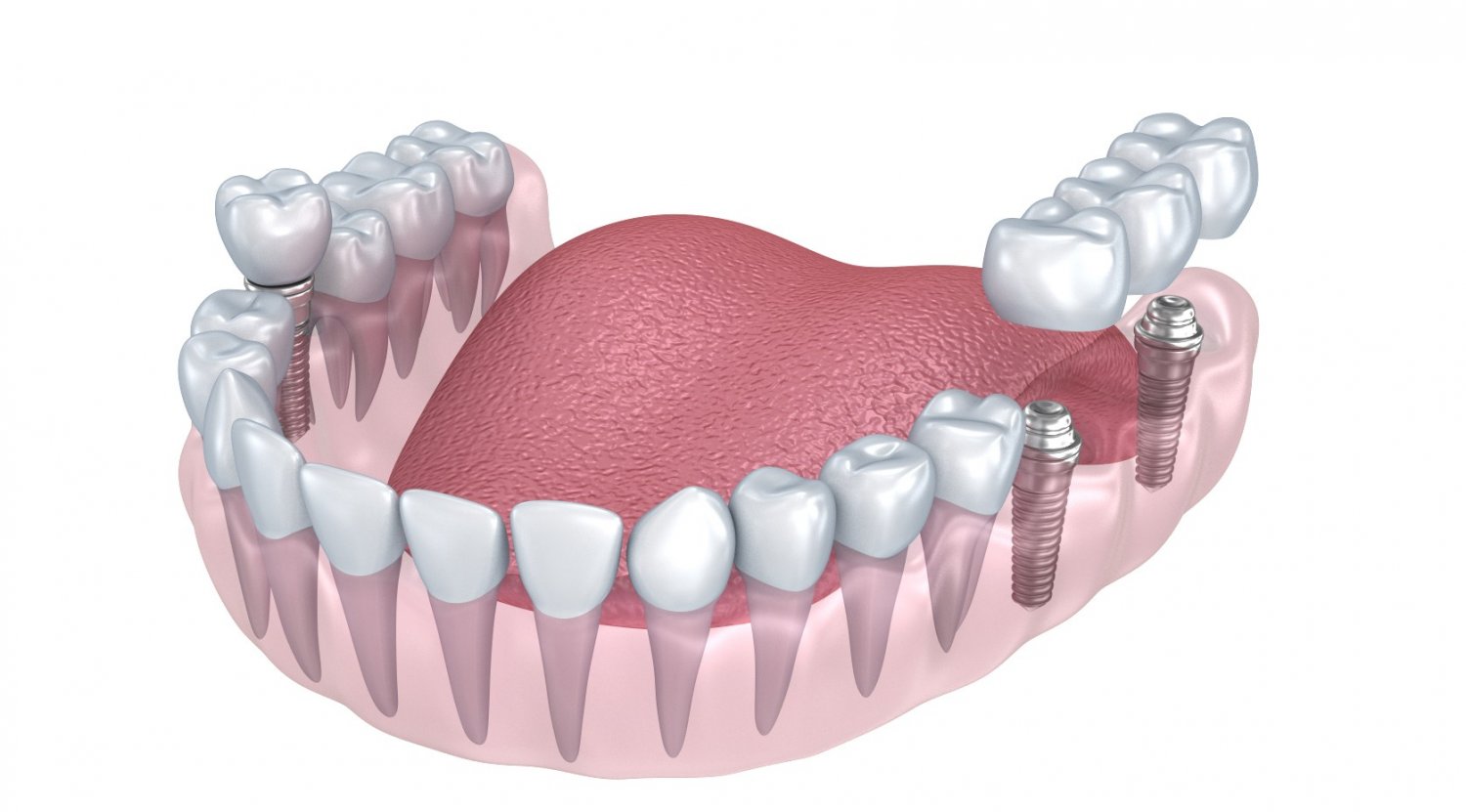 Детское протезирование зубов. Плакаты бюгельное протезирование зубов. Teeth Implant 3d.