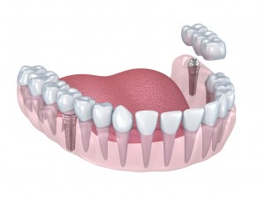 lower teeth crown and dental implant 3D Модель