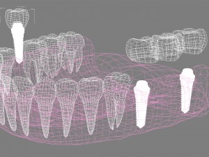 lower teeth crown and dental implant 3D Модель