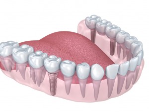lower teeth crown and dental implant 3D Модель