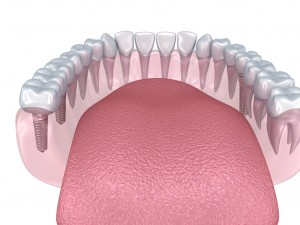 lower teeth crown and dental implant 3D Модель