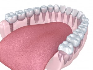 lower teeth crown and dental implant 3D Модель