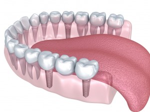 lower teeth crown and dental implant 3D Модель