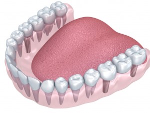 lower teeth crown and dental implant 3D Модель