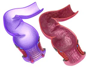 insan anatomisi rektum ve hemoroid 3D Model
