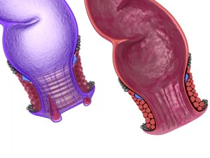 human anatomy rectum and hemorrhoids 3D Model