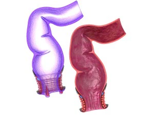 human anatomy rectum and hemorrhoids 3D Model