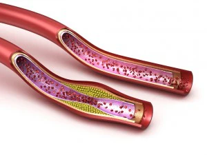 Кровеносный сосуд в норме и сосуд, поврежденный холестерином 3D Модель