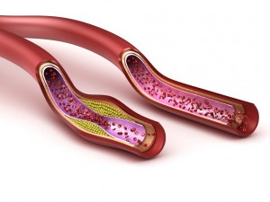 blood vessel normal and cholesterol damaged vessel Model 3D