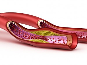 blood vessel normal and cholesterol damaged vessel Model 3D
