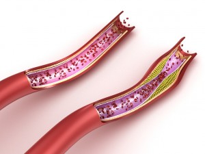 blood vessel normal and cholesterol damaged vessel Model 3D
