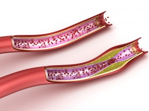 blood vessel normal and cholesterol damaged vessel Model 3D