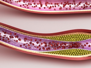 blood vessel normal and cholesterol damaged vessel Model 3D