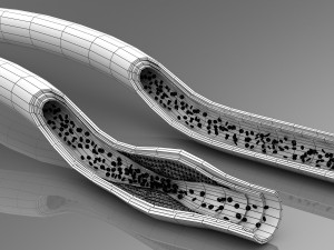 blood vessel normal and cholesterol damaged vessel Model 3D