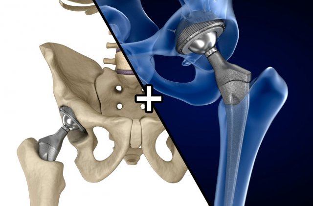 hip replacement implant installed in the pelvis bone 3D Model .c4d .max .obj .3ds .fbx .stl .blend 
