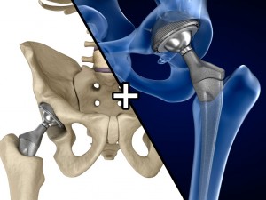 hip replacement implant installed in the pelvis bone 3D Model