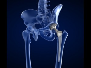 hip replacement implant installed in the pelvis bone 3D Model