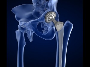 hip replacement implant installed in the pelvis bone 3D Model