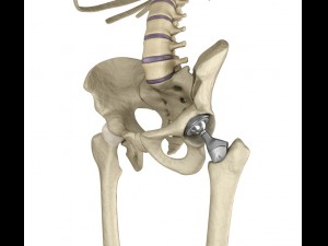 hip replacement implant installed in the pelvis bone 3D Model
