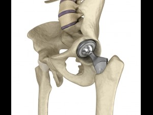 hip replacement implant installed in the pelvis bone 3D Model
