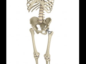 hip replacement implant installed in the pelvis bone 3D Model
