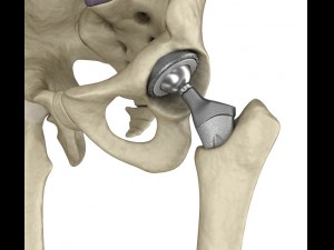 hip replacement implant installed in the pelvis bone 3D Model